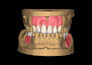 design partial dentures in exocad